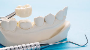Porcelain dental crown held by dental tweezers above a tooth model