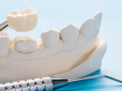 Porcelain dental crown held by dental tweezers above a tooth model
