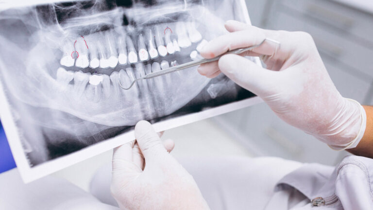 Gloved hands holding a panoramic dental X-ray of the upper and lower jaw