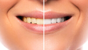 Close up of female mouth. Comparison after teeth whitening