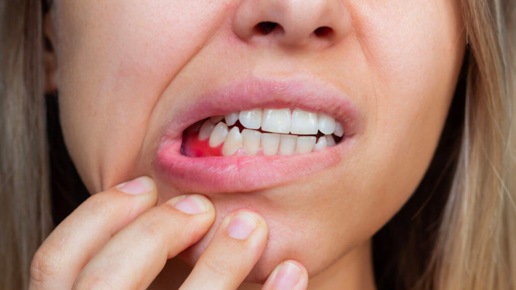 Young woman showing her gum disease symptoms, including red, inflamed gums.