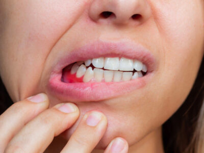 Young woman showing her gum disease symptoms, including red, inflamed gums.