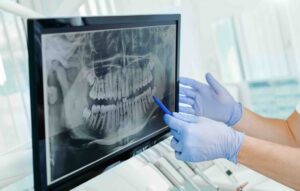 Gloved hands pointing to a panoramic dental X-ray on a monitor