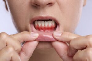 Woman showing inflamed gum on light background, closeup